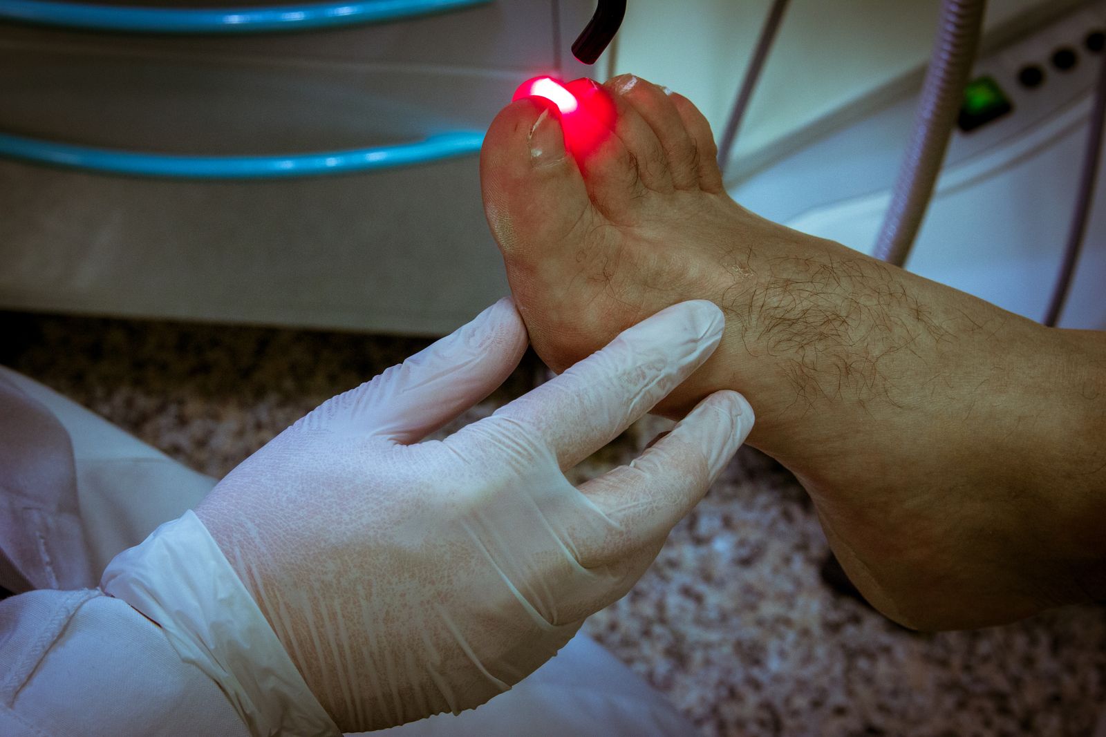 Laser terapia podologica LUMIX sull'alluce di un paziente, studio di podologia a Negrar