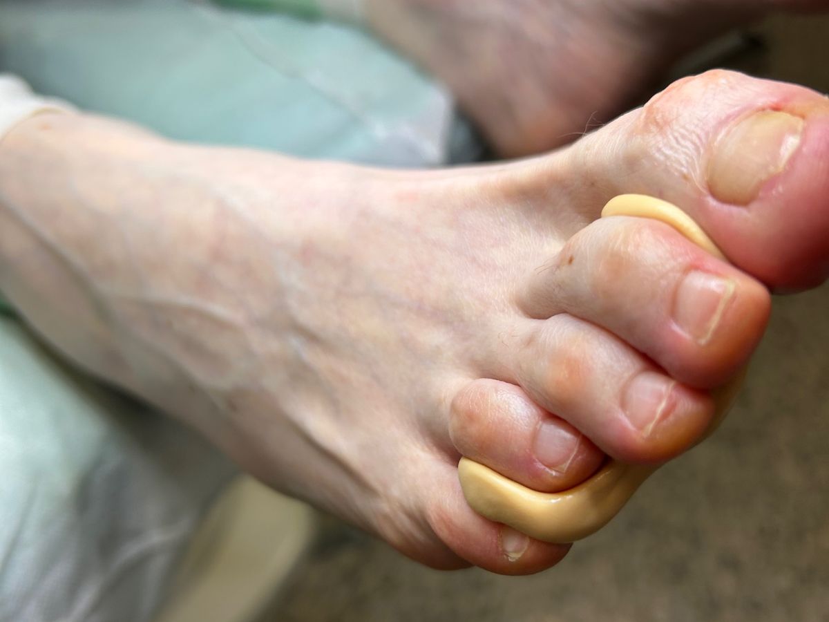 Ortesi in silicone applicata tra le dita del piede