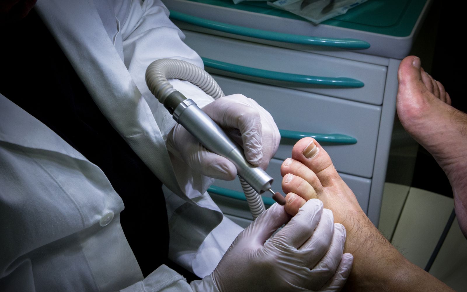 Trattamento podologico con micromotore